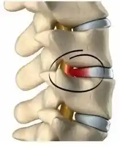 Przepuklinadyskopatia-FizjoRecover