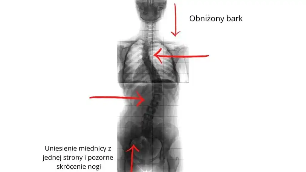 Wada-postawy-dzieci-korekcja-kielce_