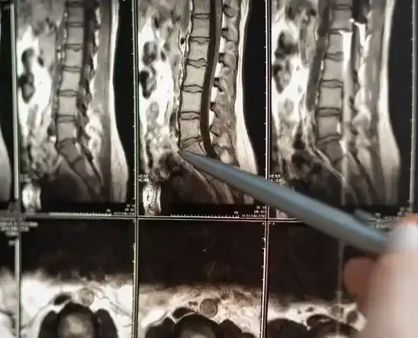 Dyskopatia Kręgosłupa