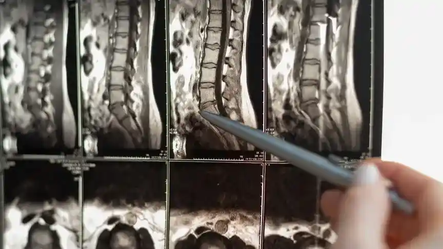 dyskopatia-kregoslupa_Kielce FizjoRecover