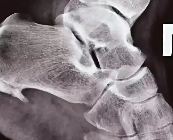 ostroga-pietowa Fizjoterapia FizjoRecover