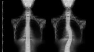 skolioza-kielce-leczenie_