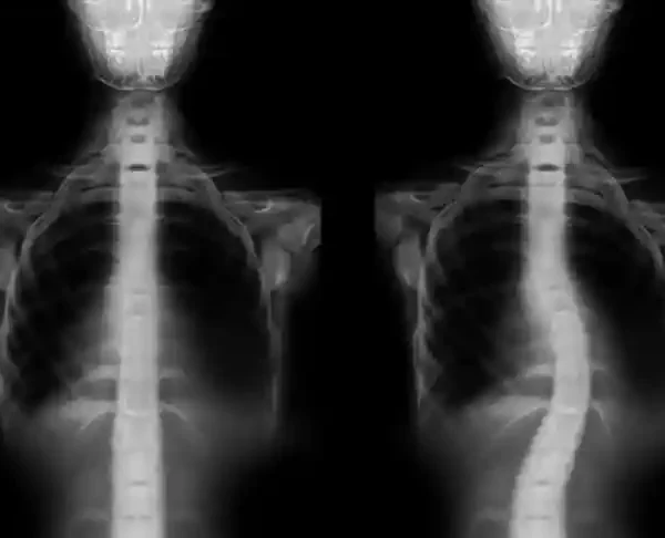 skolioza-kielce-leczenie_