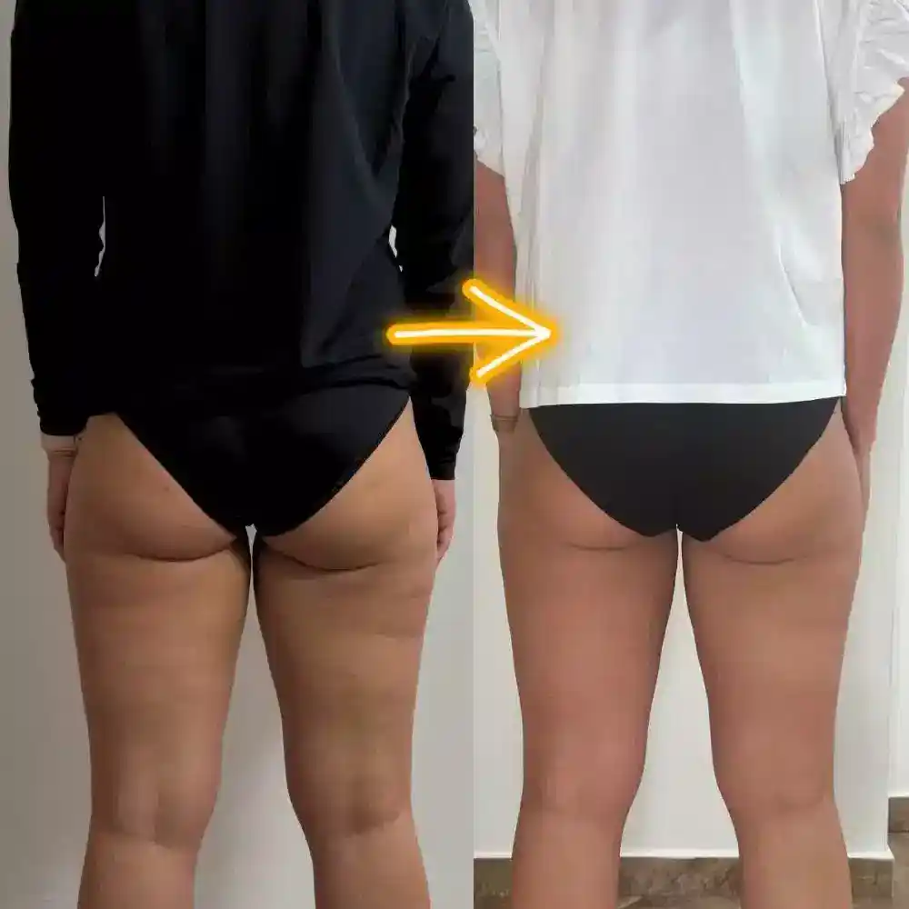 Fala-uderzeniowa-przed-i-po-cellulit-kielce-fala-uderzeniowa-cellulit